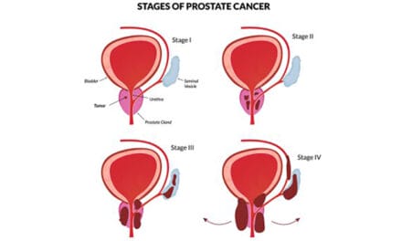 Joe Biden’s Prostate Cancer is a wake-up call: Jewish people are at elevated risk